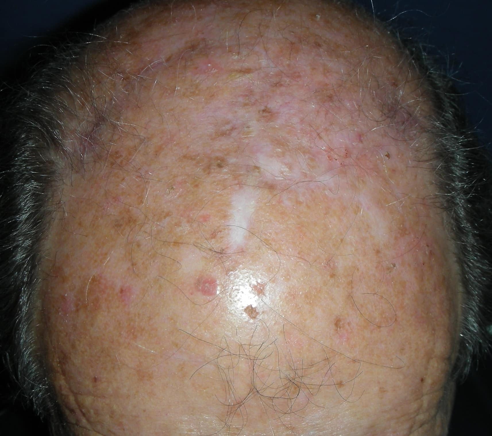 Skin Cancer On Top Of Head