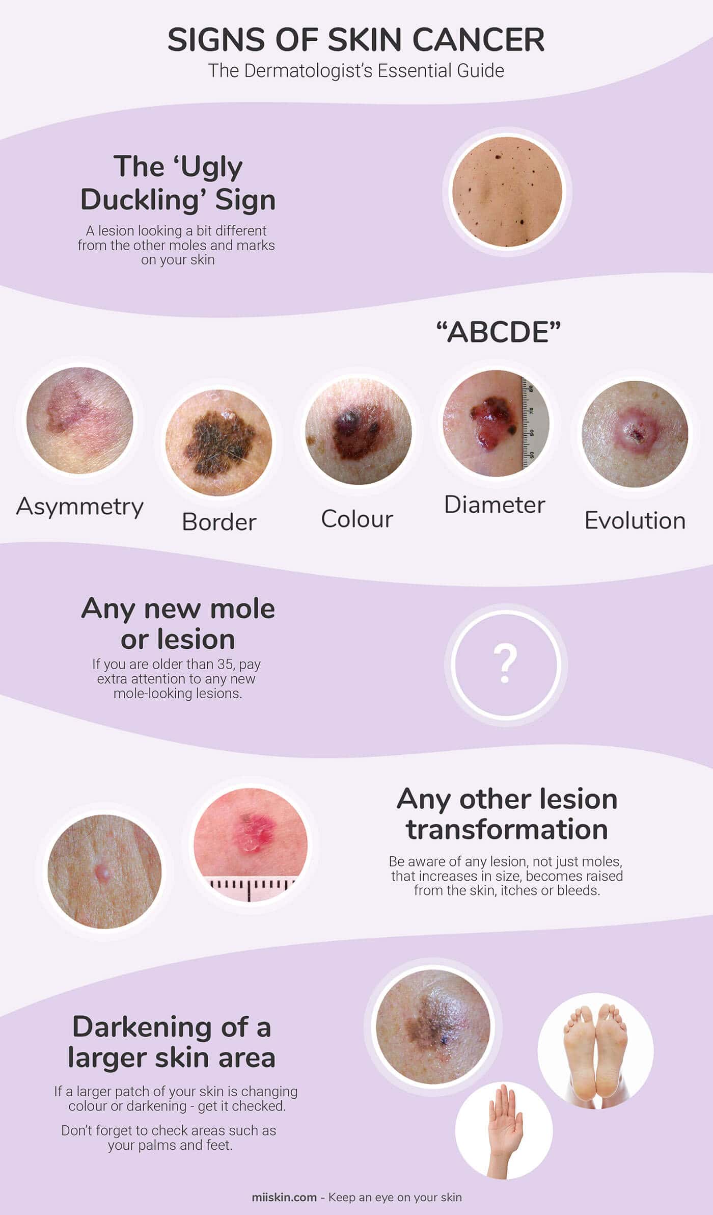 Skin Cancer Signs &  Symptoms