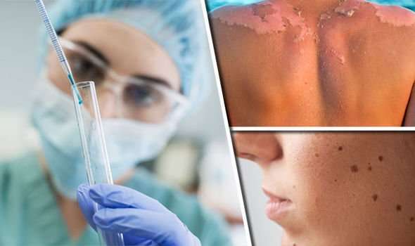 Skin cancer spread stopped: Disease TREATED with ...