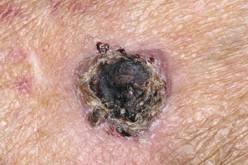 Skin cancer, squamous cell carcinoma
