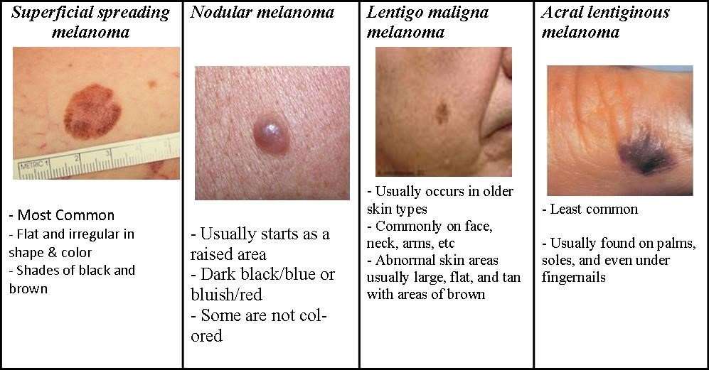 Skin Cancer Stage 4 Melanoma