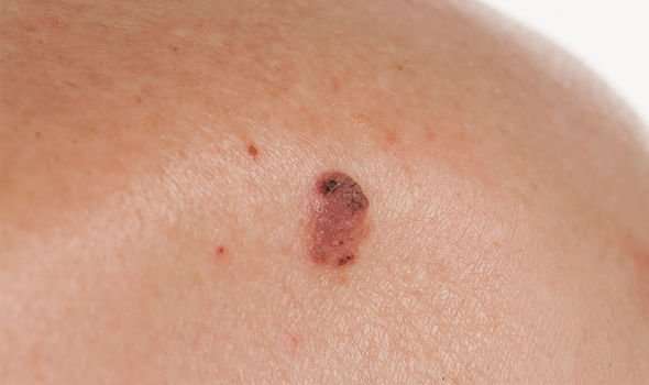 Skin cancer symptoms: Four warning signs your mole is ...