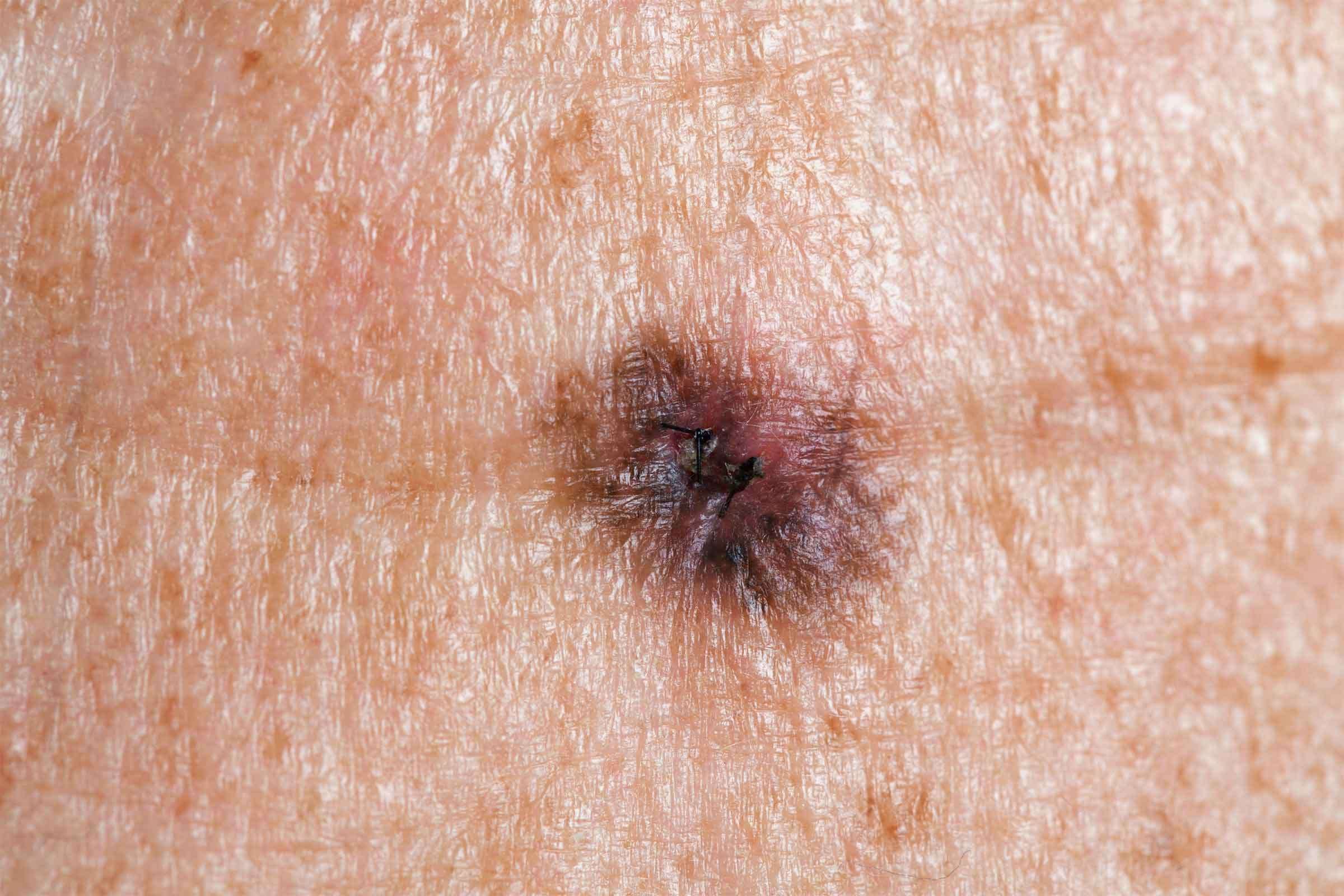 Skin Cancer Symptoms: How to Check for Moles