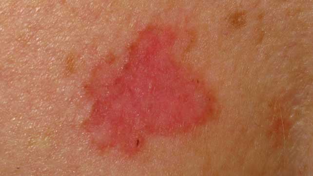 Skin Cancer Symptoms: Pictures, Types, and More