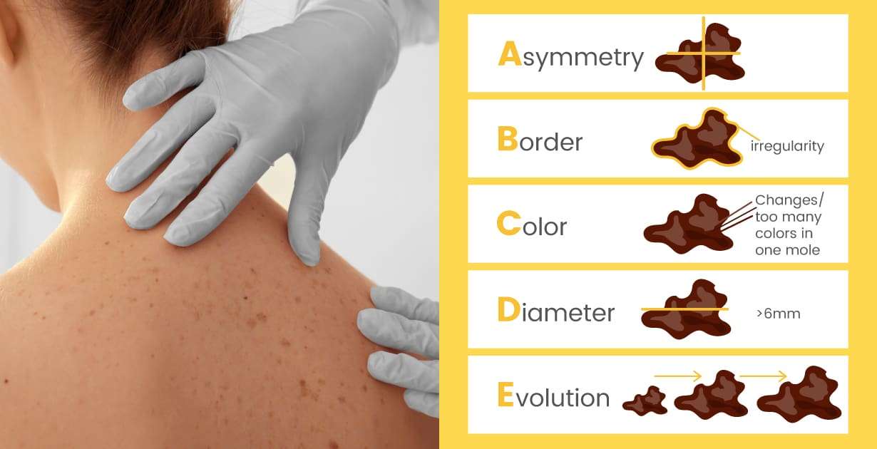 Skin Cancer Symptoms + Prevention & Natural Therapies