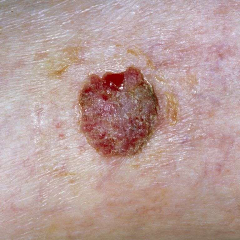 Skin Cancer Symptoms, Signs, Types, Treatments &  Prevention