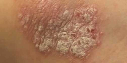 Skin Cancer Symptoms You Should Not Ignore