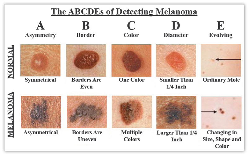 Skin Cancer Treatment New Orleans