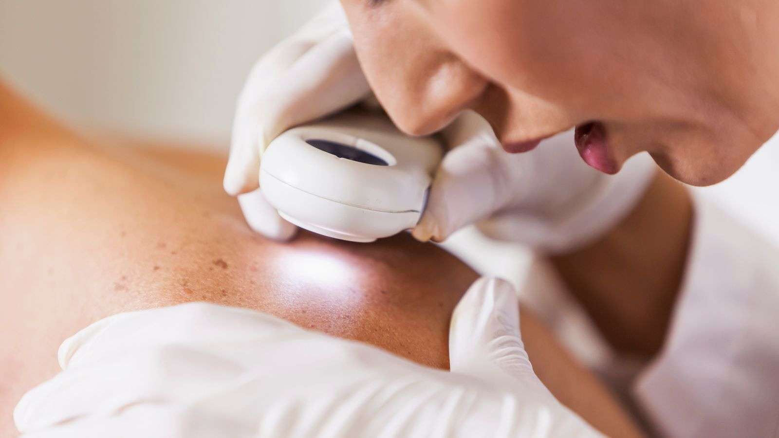 Skin cancer warning after 150% rise in UK deaths since ...