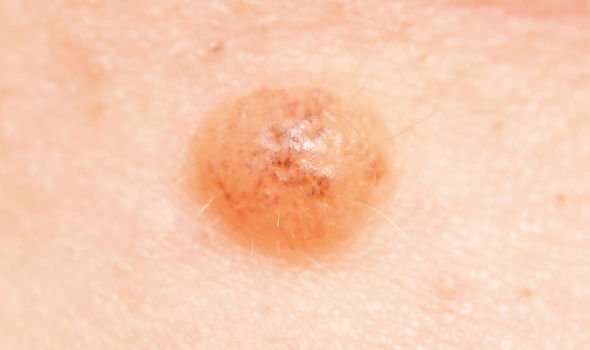 Skin cancer warning: Does your mole look like this? Pictures reveal ...