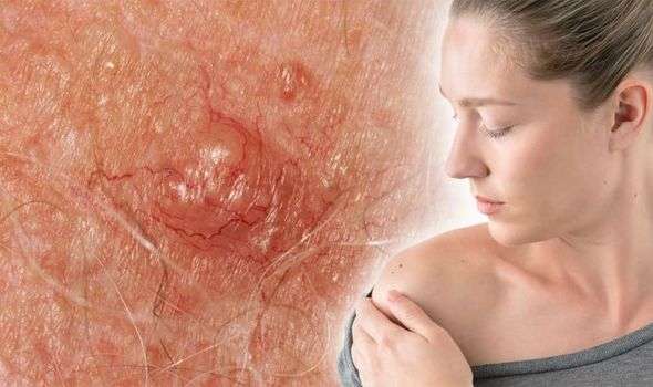 Skin cancer warning: Itchy spot could be sign other than a ...