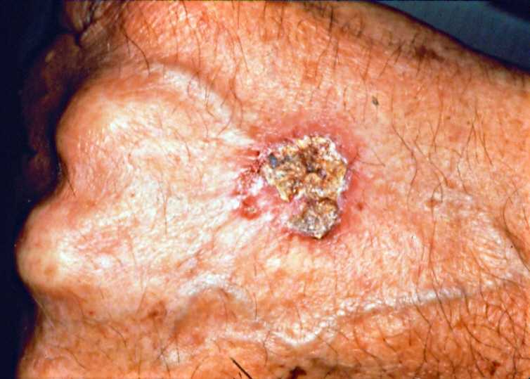 Skin cancer: what you need to know