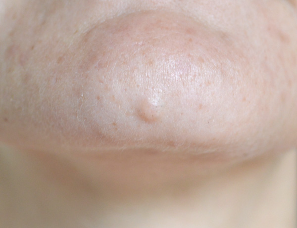 Skin Colored Moles On Face Removal