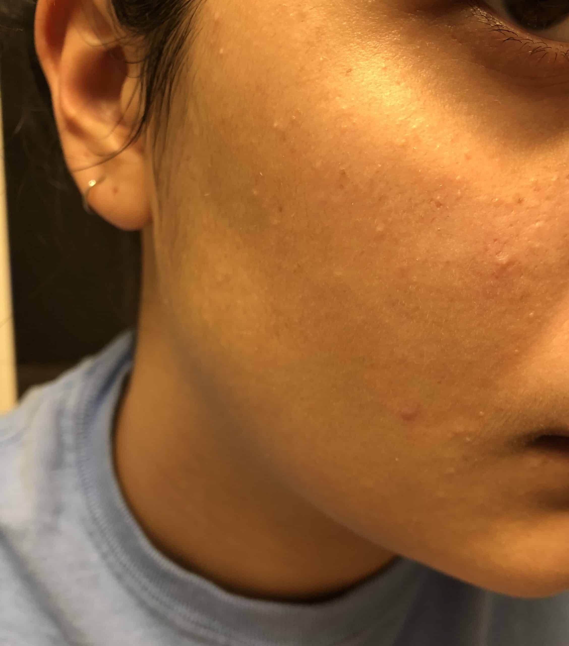 [Skin Concern] I just noticed all these little white bumps on my face ...