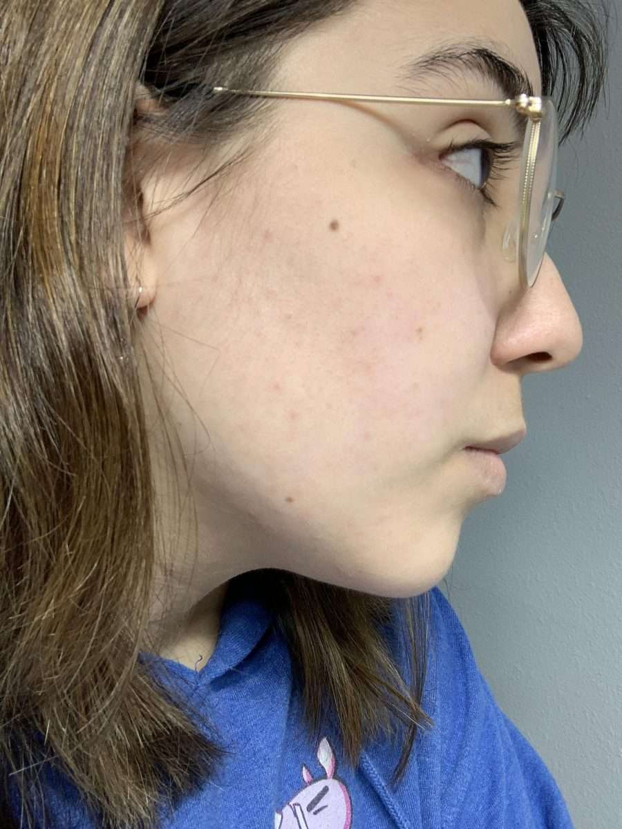 [Skin Concern] Ive had these red bumps on my face for about a year ...