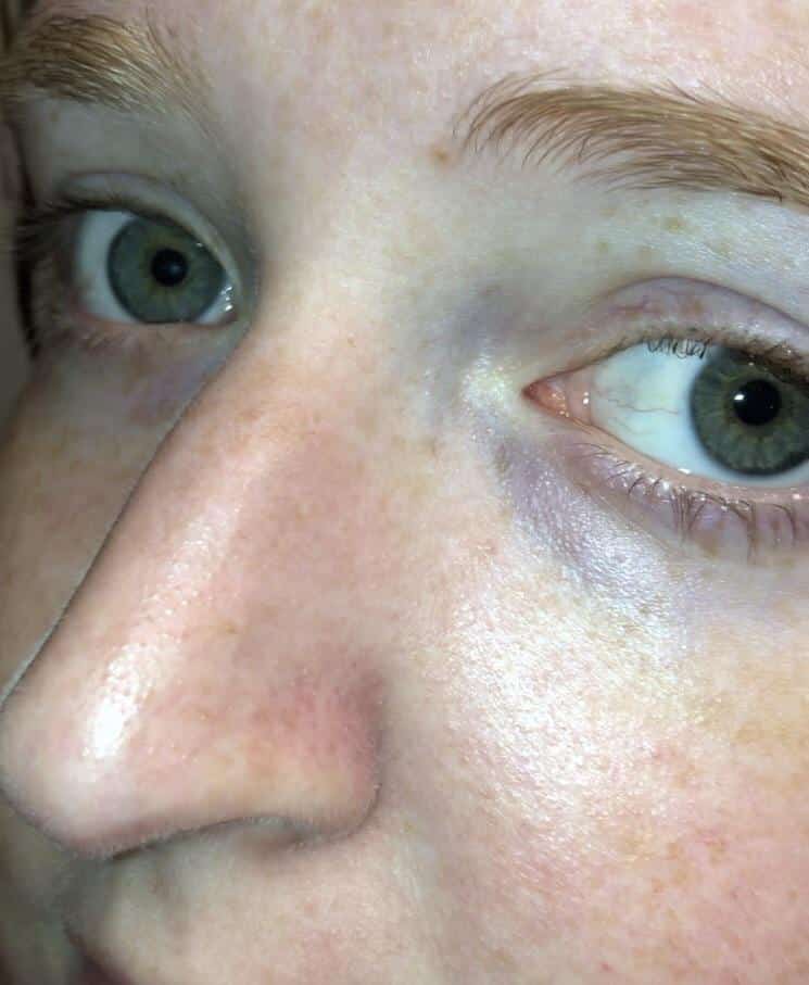 [Skin Concern] What can I do about the uneven texture on my nose and ...