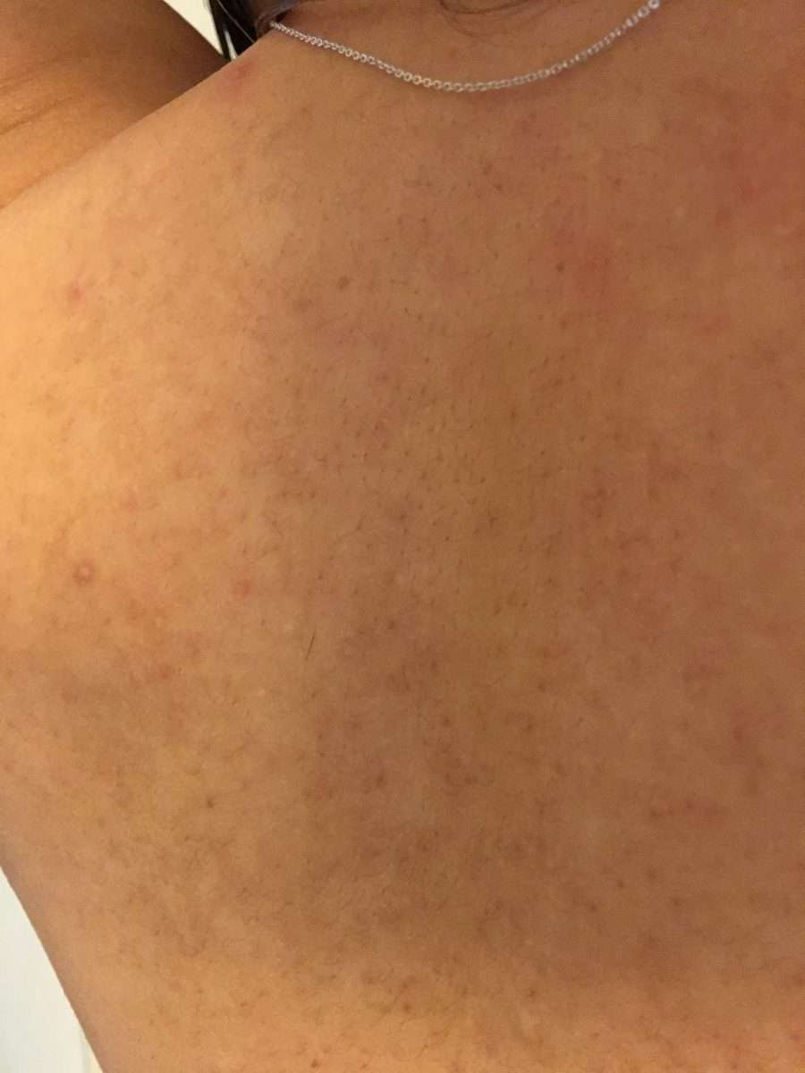 [Skin Concerns] Any ideas what these dark spots are on my back ...