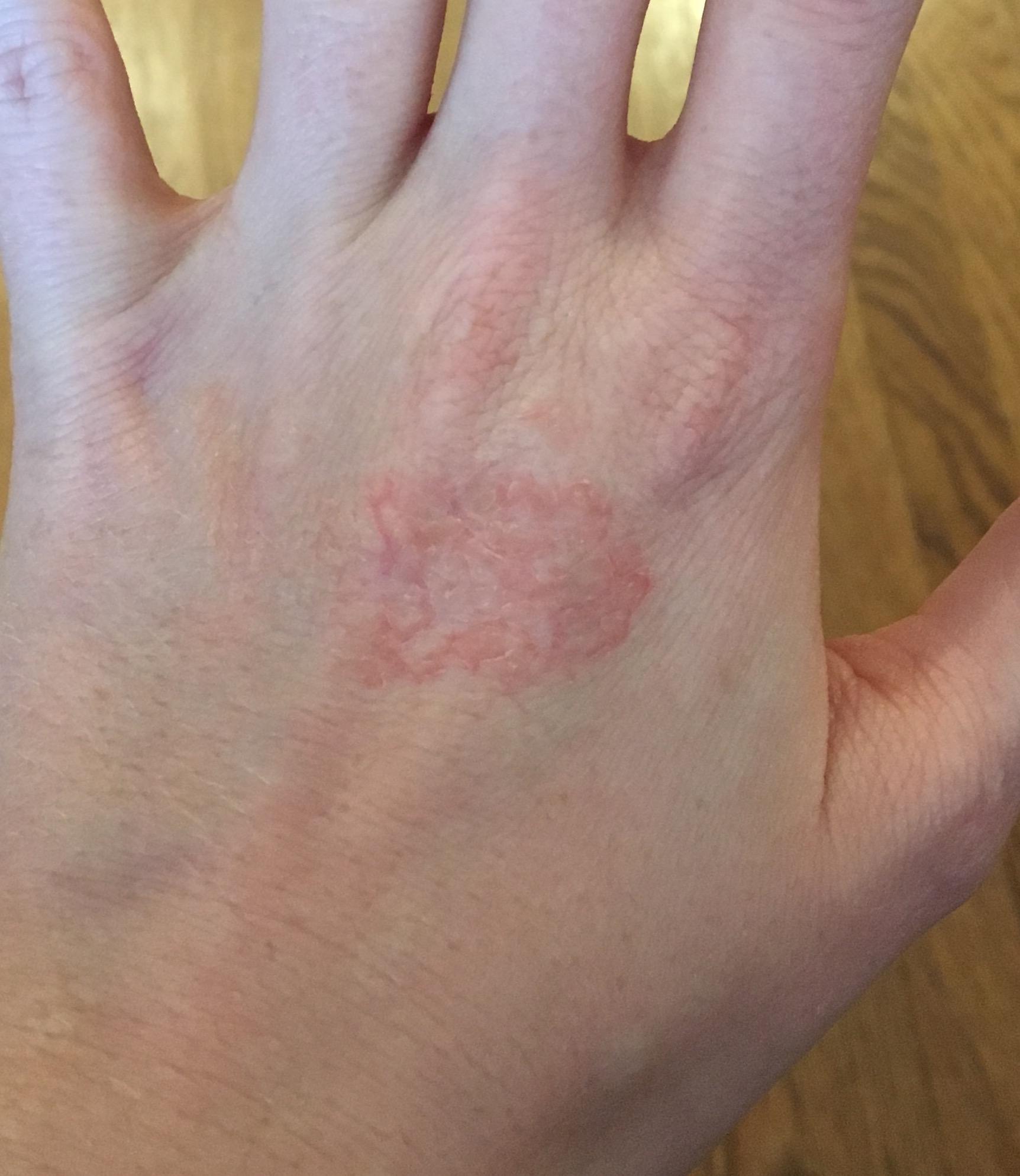 [Skin Concerns] Does anyone know what this patch of dry skin is? Eczema ...