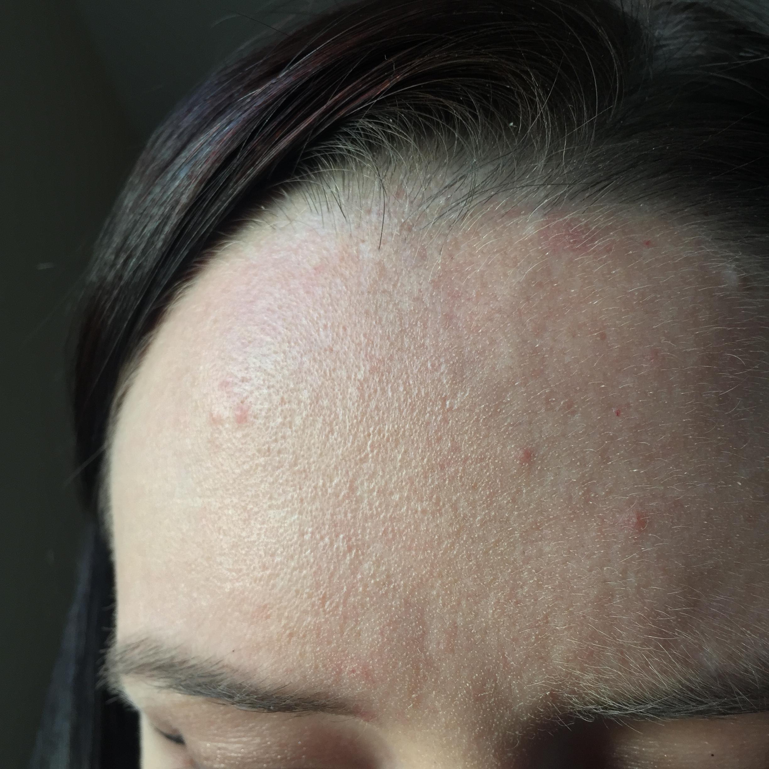 [skin concerns] dry flaky forehead and pimples that sometimes burn or ...