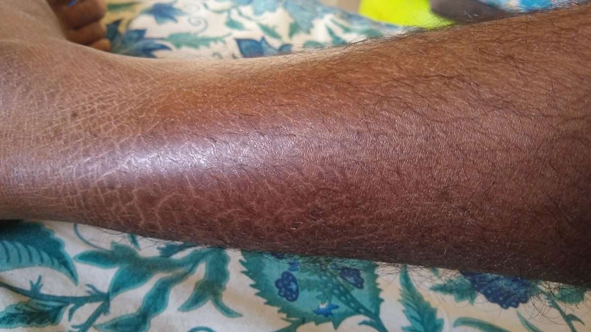 [Skin Concerns] how do I fix the cracks on my legs? Dry skin, don