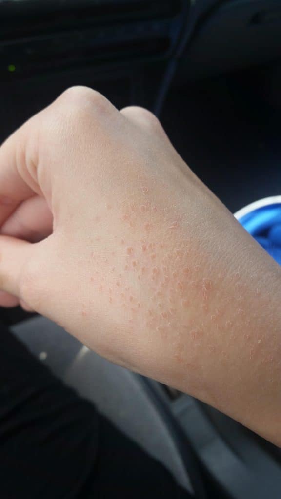 Skin Bumps On Hands