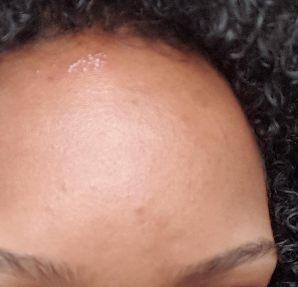 [Skin concerns] Little white bumps appeared over night. What should I ...