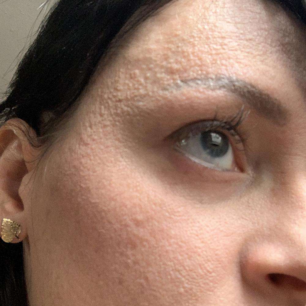 [Skin Concerns] Permanently bumpy and rough skin texture that nothing ...