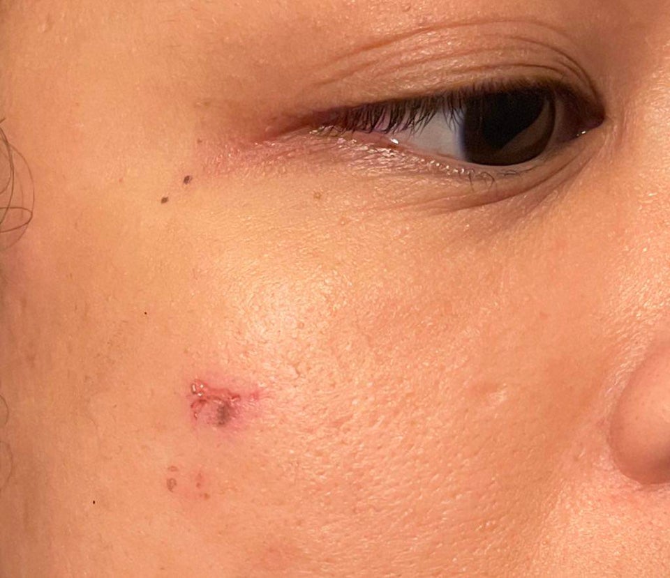 [Skin Concerns] Reaction to Hada Labo Hyaluronic Acid. It looks like my ...