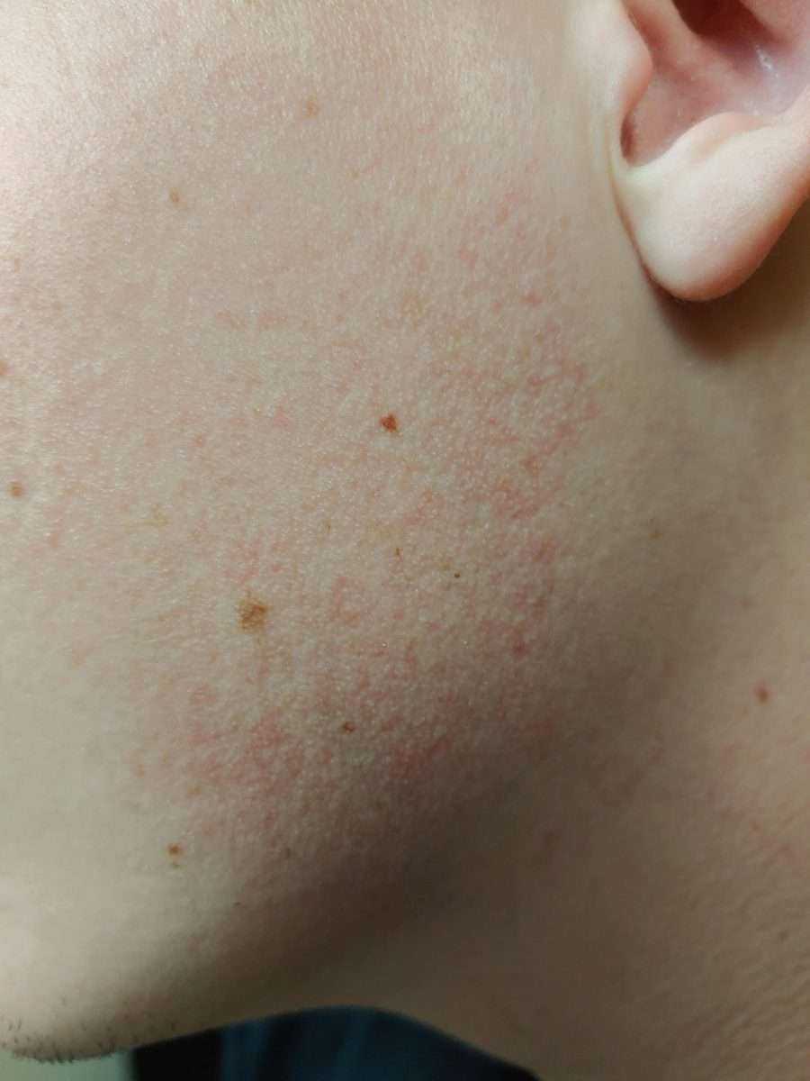 [Skin Concerns] Rough. Dry. Bumpy. Red. On both cheeks. I use CeRave ...