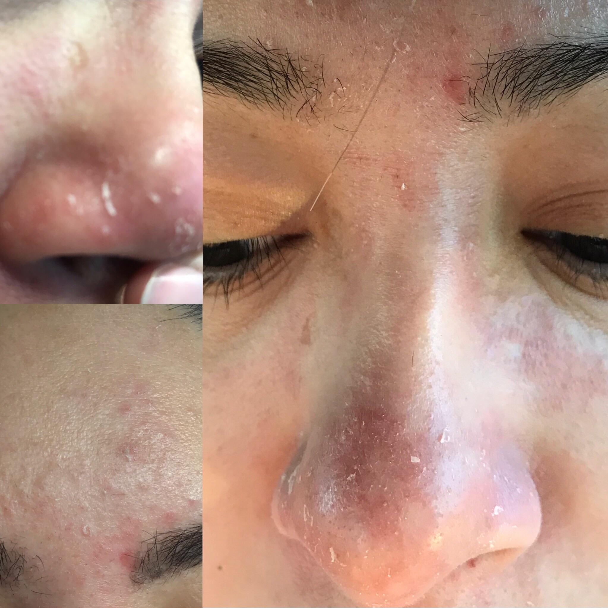 [Skin Concerns] [Routine Help] Dry and flaky skin on my nose and ...