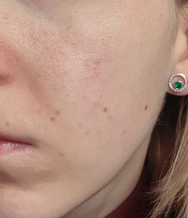 [Skin Concerns] What is wrong with my skin? Why do I get those red ...