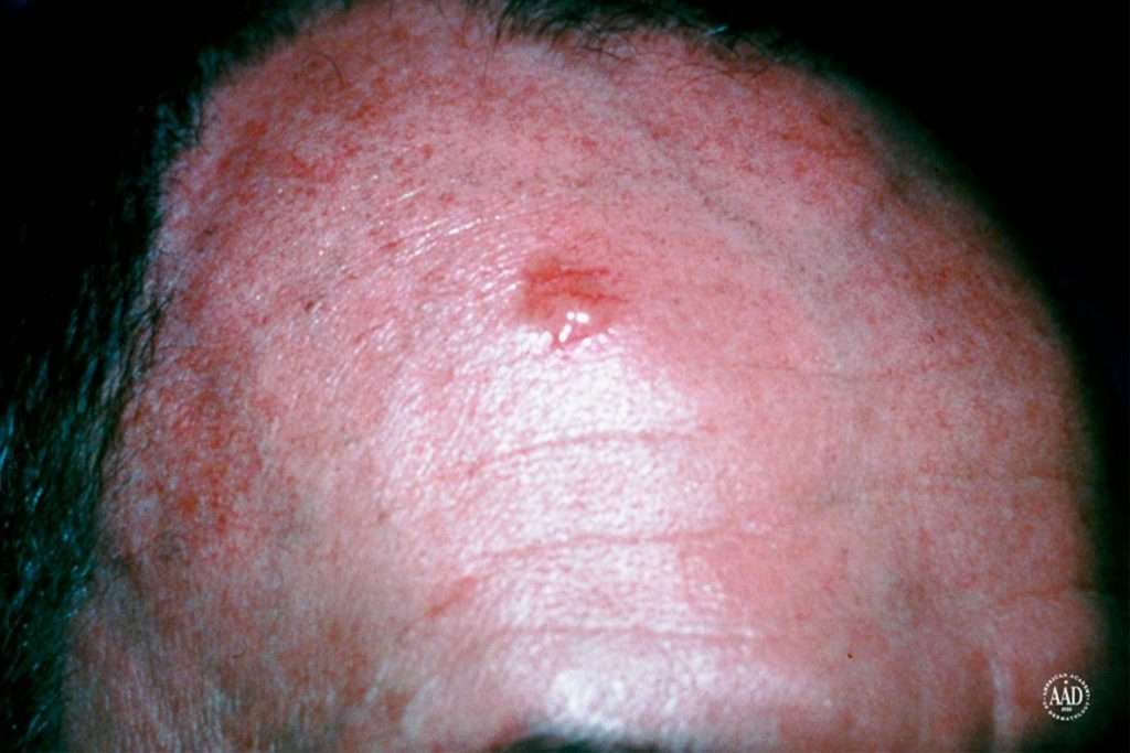 Skin Conditions That Look Like Acne But Arenât
