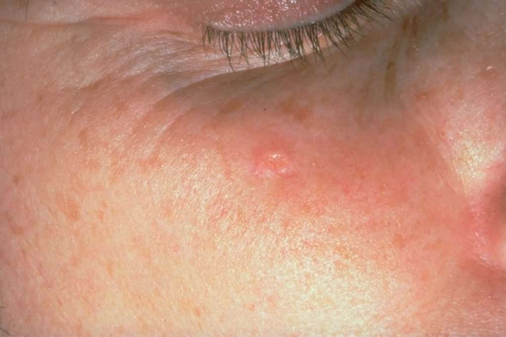 Skin Conditions That Look Like Acne