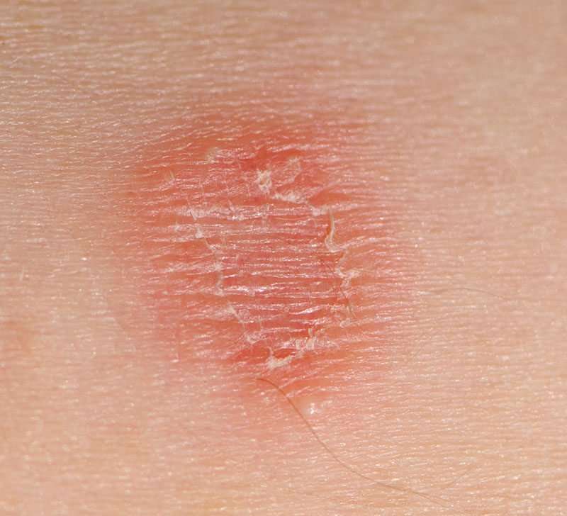 Skin lesions: Pictures, treatments, and causes