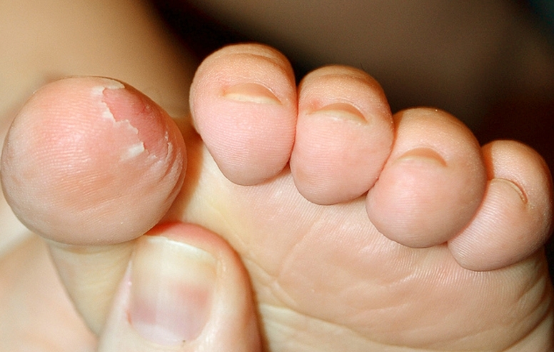 Skin Peeling on Feet