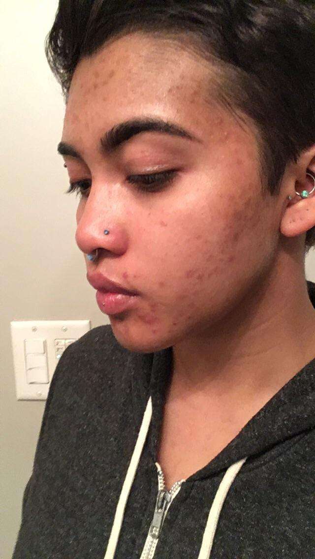 Skin picking out of control due to stress acne. My whole face burns but ...