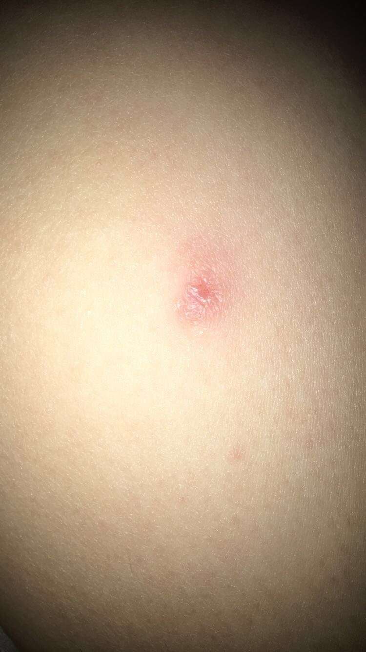 Skin rash or is this spot skin cancer?