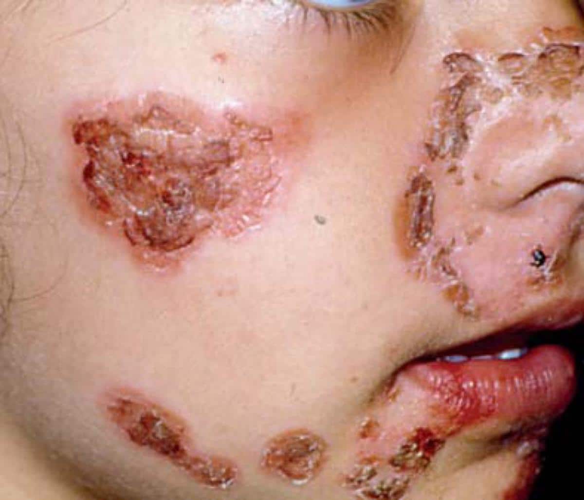 Skin Staph Infections with Pictures