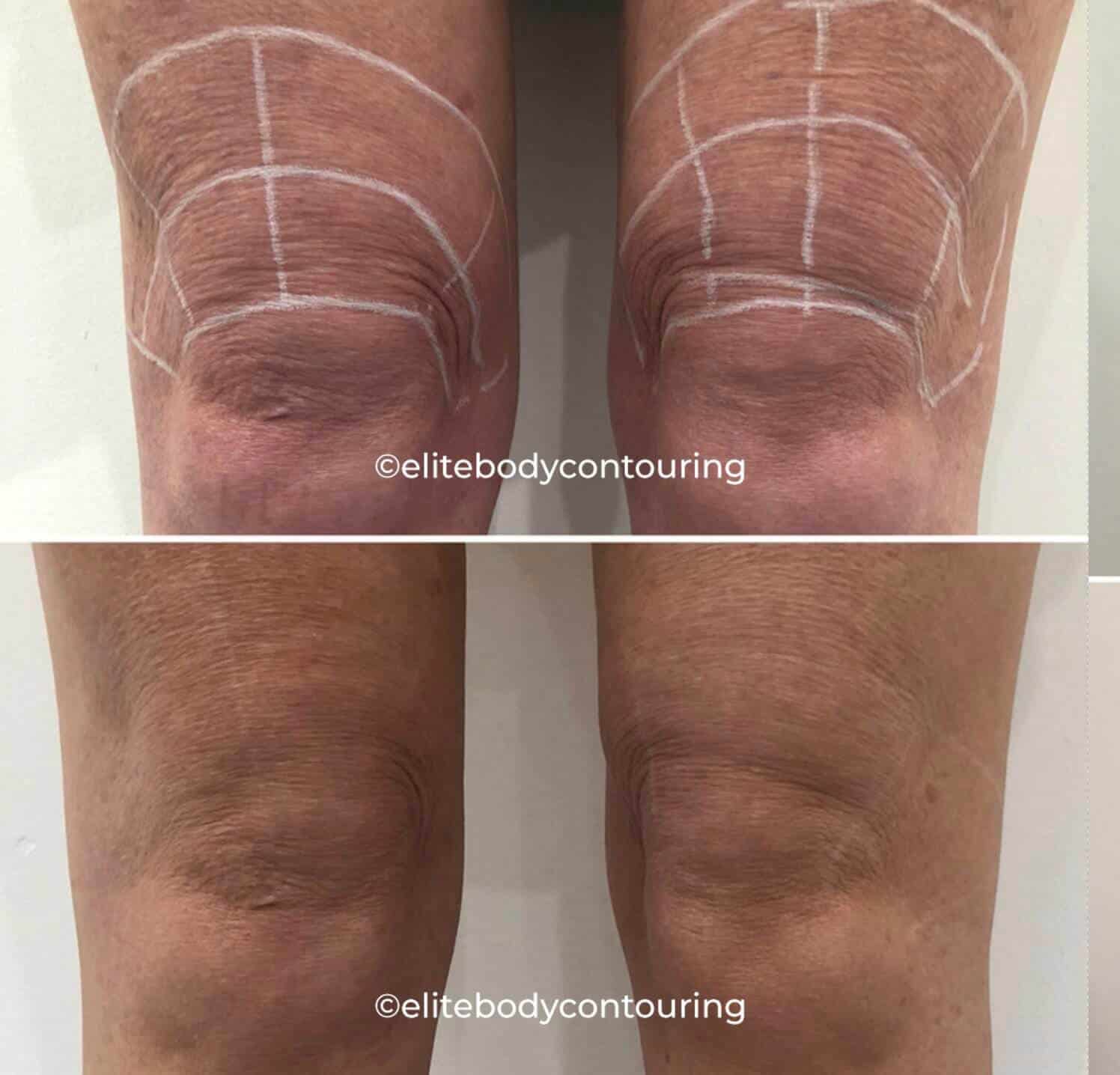 Skin Tightening Reviews &  Results: Non
