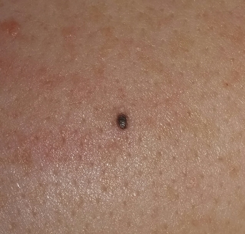 small black spot found on upper back
