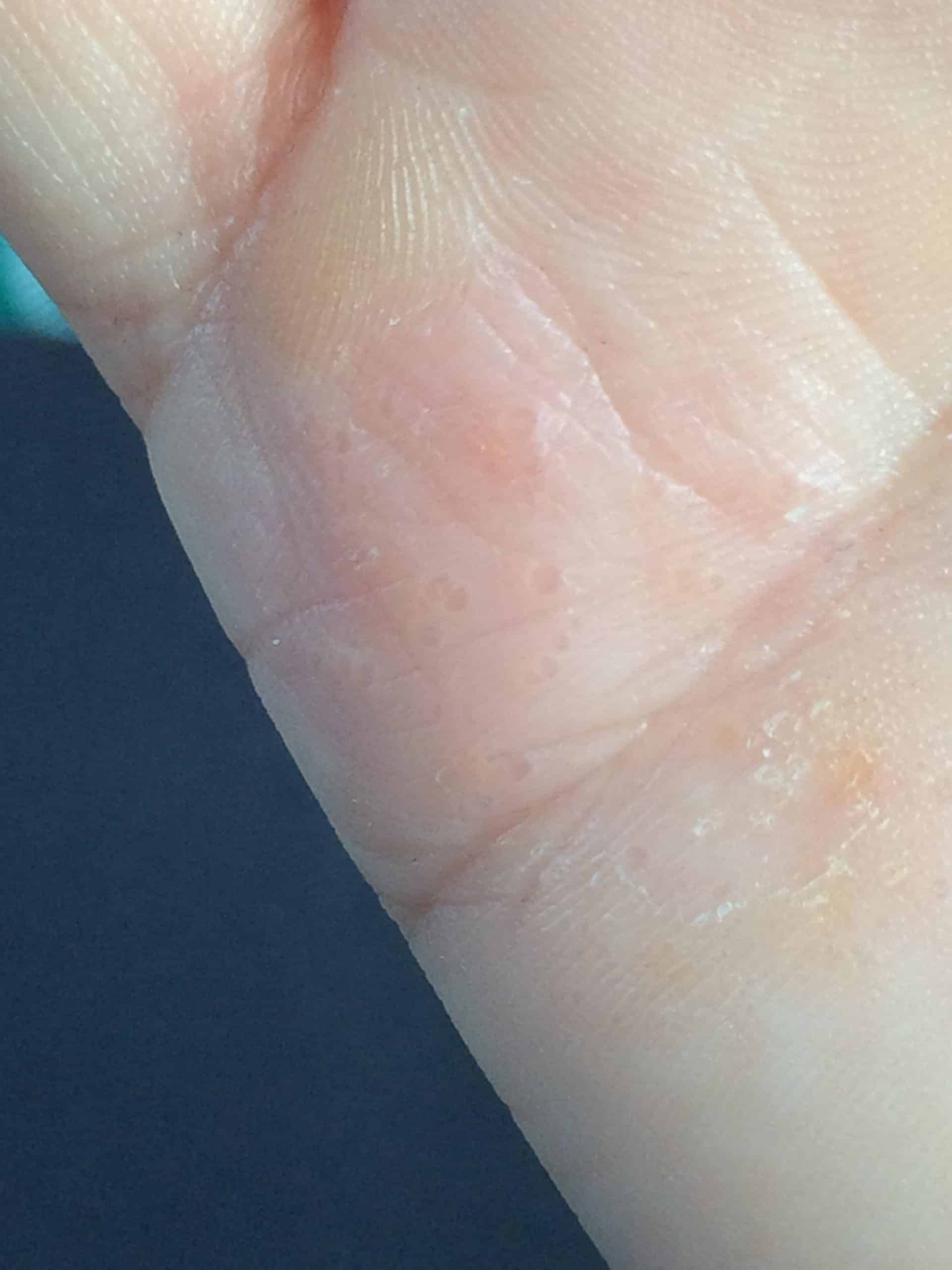 Small bumps/bubbles on hand? Any idea what these might be? : Dermatology