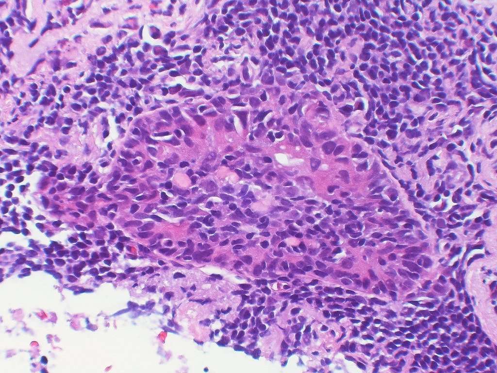 Small cell squamous cell carcinoma Case 247
