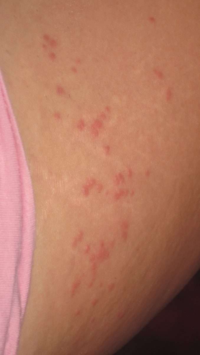 small itchy bumps