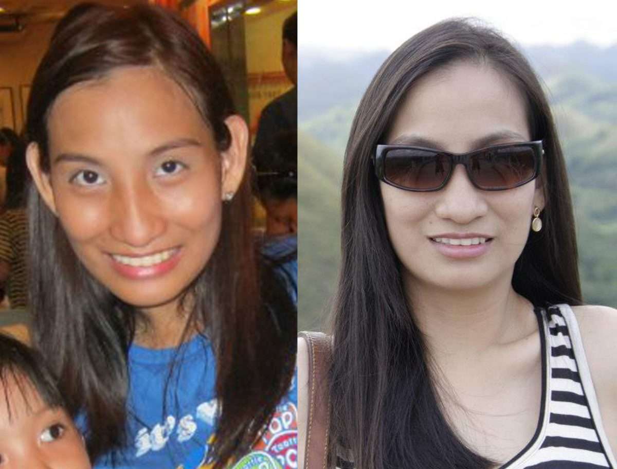 some of glutathione injectable before and after pics. Results are not ...