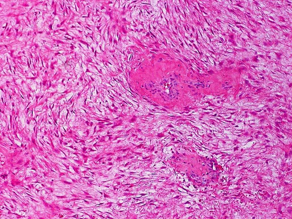 Spindle cell carcinoma of the breast looks alot like Lyme ...
