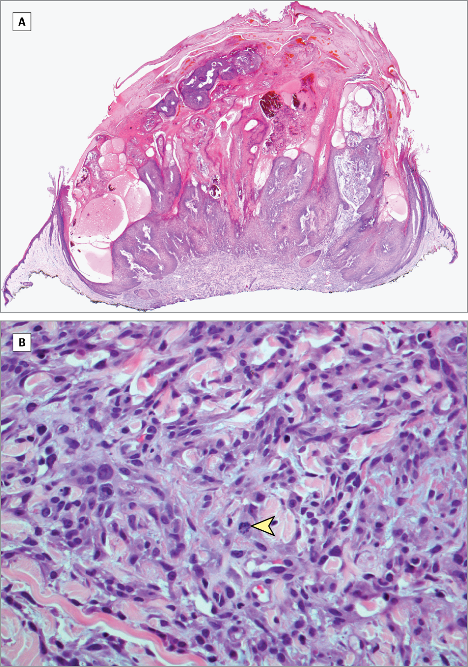 Spindle Cell Squamous Carcinoma During BRAF Inhibitor ...