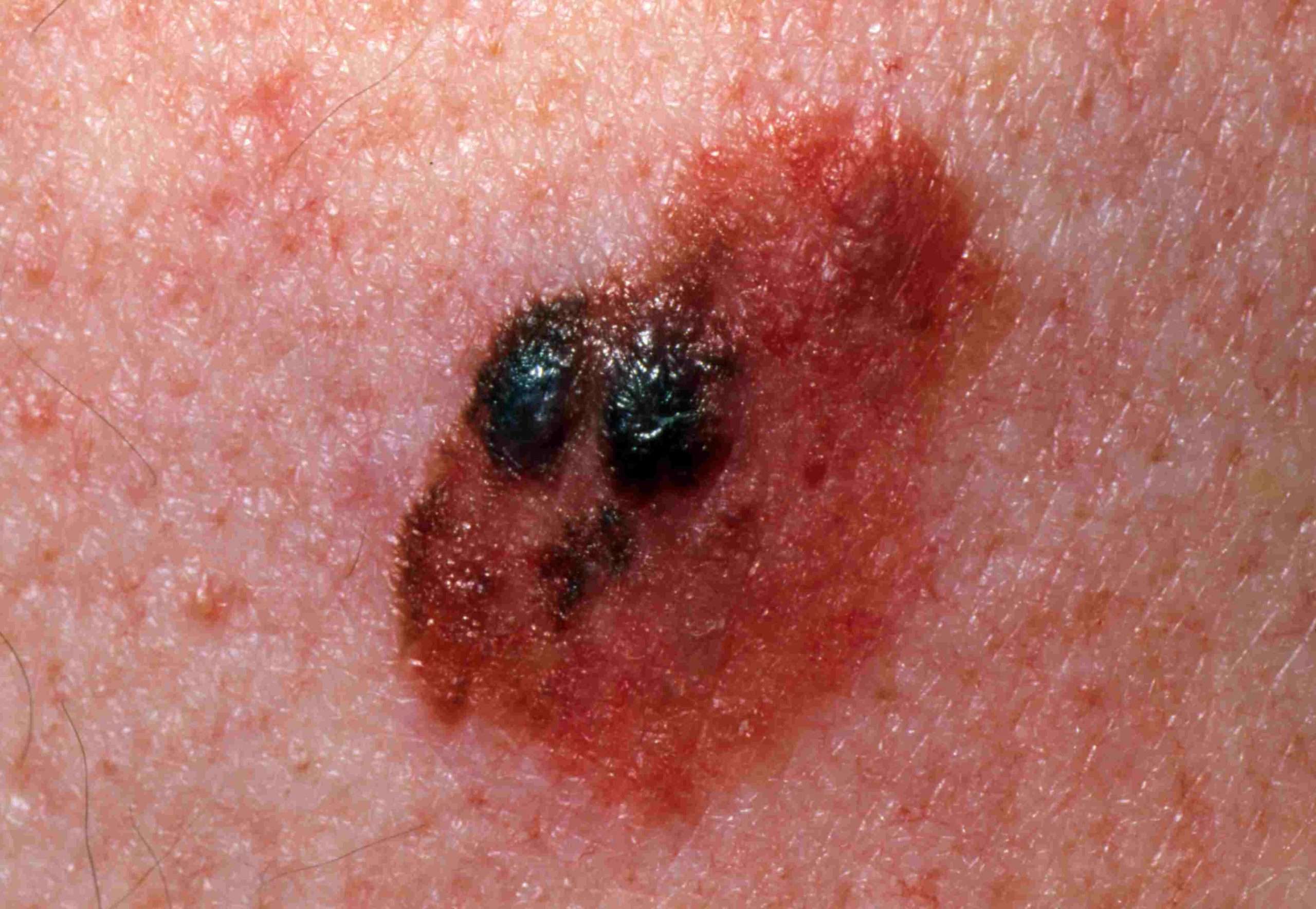 Spot the Differences Between a Mole and Skin Cancer