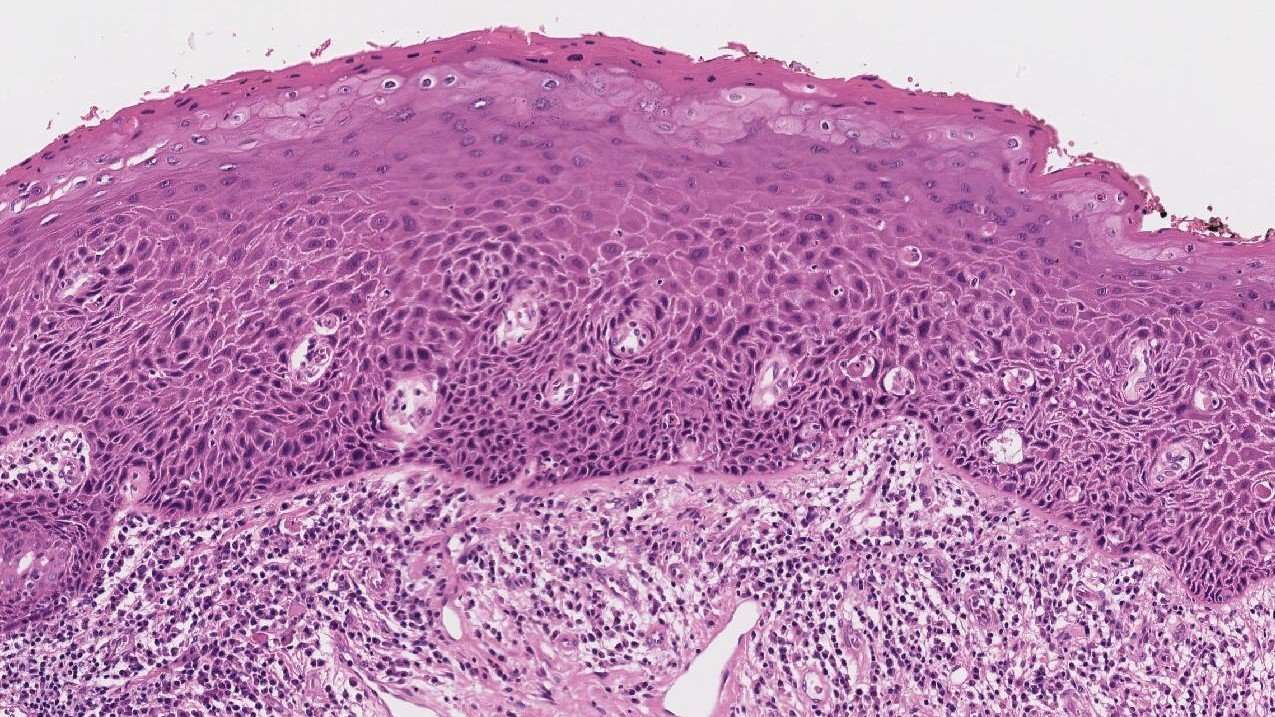 Squamous carcinoma in situ of the larynx