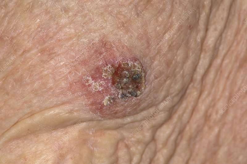 Squamous cell cancer on the arm