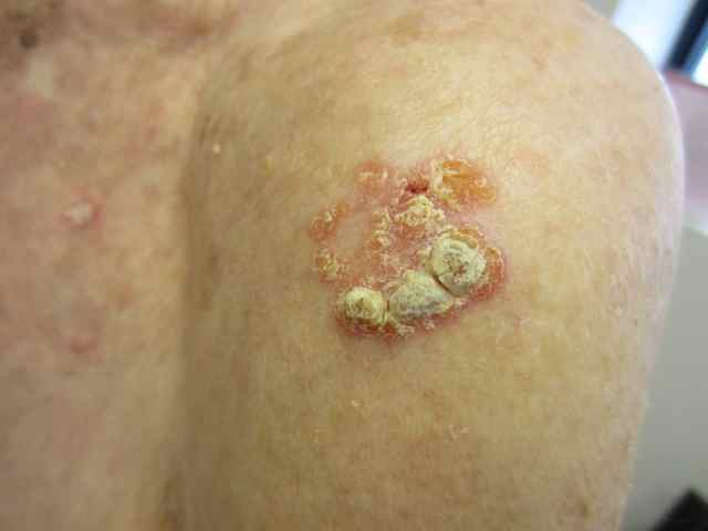 Squamous cell cancer (SCC)